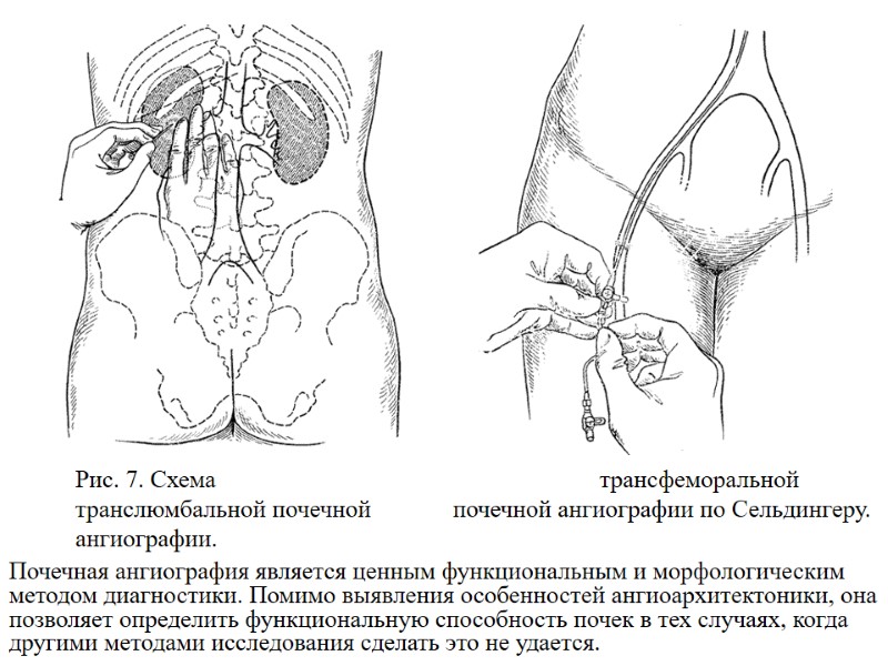 Рис. 7. Схема транслюмбальной почечной ангиографии. Рис. 8. Схема трансфеморальной почечной ангиографии по Сельдингеру.